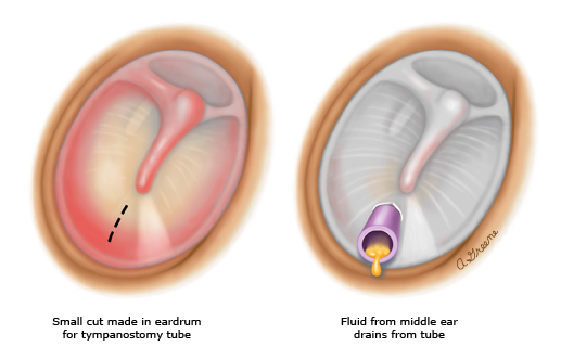 prednisone for fluid in ear